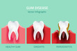 Gum disease stages. Teeth infographic