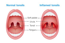 Comparison Between Normal Tonsils And Inflamed Tonsils. This Illustration About Health Care And Medical.