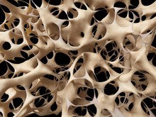 Bones With Osteoporosis, Illustration