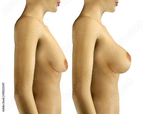 Cuadros en Lienzo 3d illustration Breast Enlargement with Uplift surgery before a