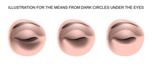 Dark Circles Under Eyes