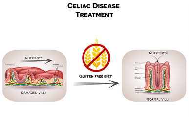 Wall Mural - Celiac disease treatment. Gluten free diet leads to healthy intestinal villi. Illustration shows unhealthy villi with damaged cells and healthy villi.