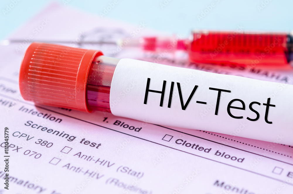 HIV test label on HIV infection screening test form. - obrazy, fototapety, plakaty 