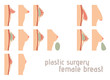 Breast augmentation infographics. Breast implants vector illustration