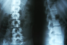 X-ray Of Human Spinal Column Closeup