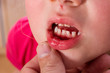 Kind mit Platzwunde an der Lippe nach einem Sturz