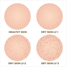 Webstep Of Healthy Skin To Dry Skin Texture , Vector
