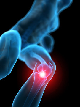 medically accurate 3d illustration of the painful knee