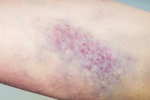 Macro Shot Of Bruise On Skin.