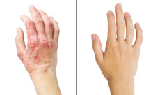 Real Photo Girl's Hand, The Patient With Eczema Before And After Treatment