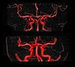 © Connect Images - MRI vascular brain radiograph, gadolinium contrast