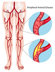 Canvas Print - Peripheral arterial disease diagram