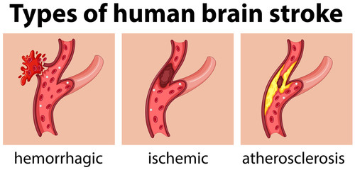 types of human brain stroke