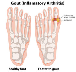 Wall Mural - Diagram explanation of Gout in human foot