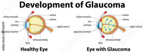 Cuadros en Lienzo Development of Glaucoma in human eyes