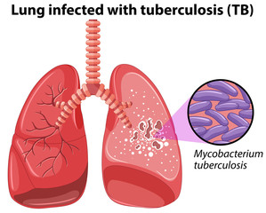 Wall Mural - Lung infected with tuberculosis