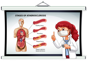 Wall Mural - Doctor explaining stages of atherosclerosis