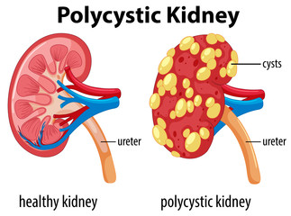 Wall Mural - Diagram showing polycystic kidney