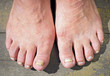 © elen31 - onychomycosis with fungal nail infection
