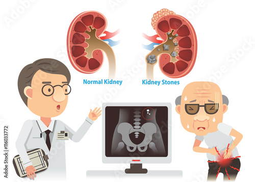 Kidney stones cartoon images Kidney Stones/Doctors are advising the old kidney stones. He with pain