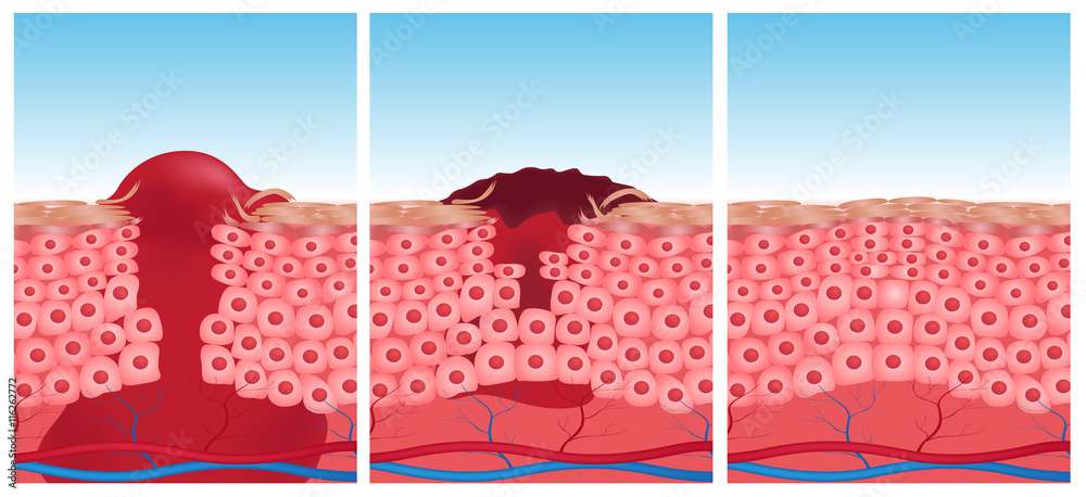 wound skin vector graphic . blood come out of wound 素材庫插圖 | Adobe Stock