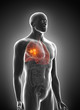 © Sebastian Kaulitzki - 3d rendered medically accurate illustration of lung cancer