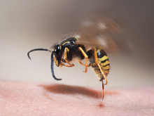 Wasp Sting Pulls Out Of Human Skin. Macro