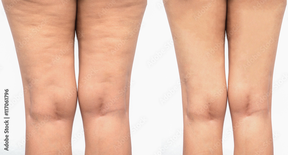 Cellulite  women. Figure of a young girl before and after. - obrazy, fototapety, plakaty 