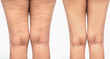 Cellulite  women. Figure of a young girl before and after.