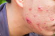 closeup horizontal photo of male cheek with big pimple or acne abcess