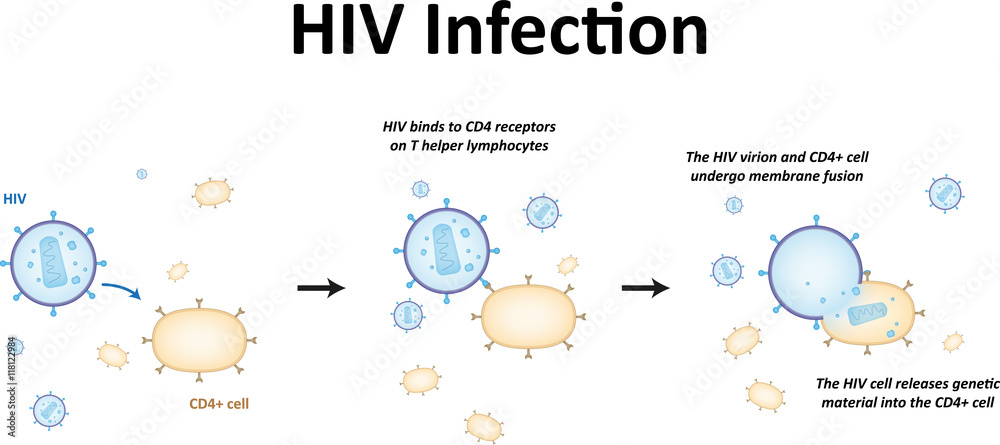 HIV Infection - obrazy, fototapety, plakaty 