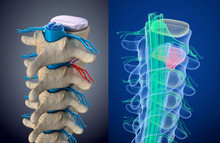 Spinal Cord Under Pressure Of Bulging Disc. Xray View. Medically Accurate 3D Illustration