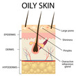 Illustration of The layers of oily skin