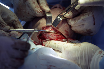 Chin surgery close-up with open wound and an incision on a bone