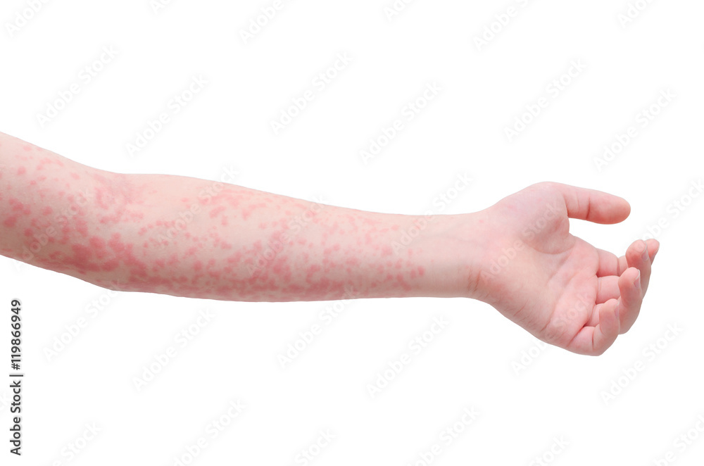 Young asian child arm skin with rash over white background - obrazy, fototapety, plakaty 