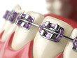 Teeth with braces or brackets in open human mouth. Dental care c