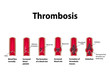 Thrombocytosis. Embolism. Infographics. Vector illustration on isolated background