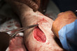 Surgeon begins to sew the wound on the leg after the operation