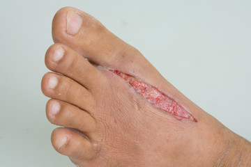 Open wounds on foot from centipede bite
