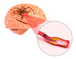 Brain stroke : 3d illustration of the vessels of the brain and causes of stroke