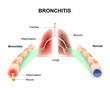 Bronchitis