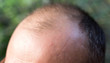 © schankz - hair loss on the head of a man