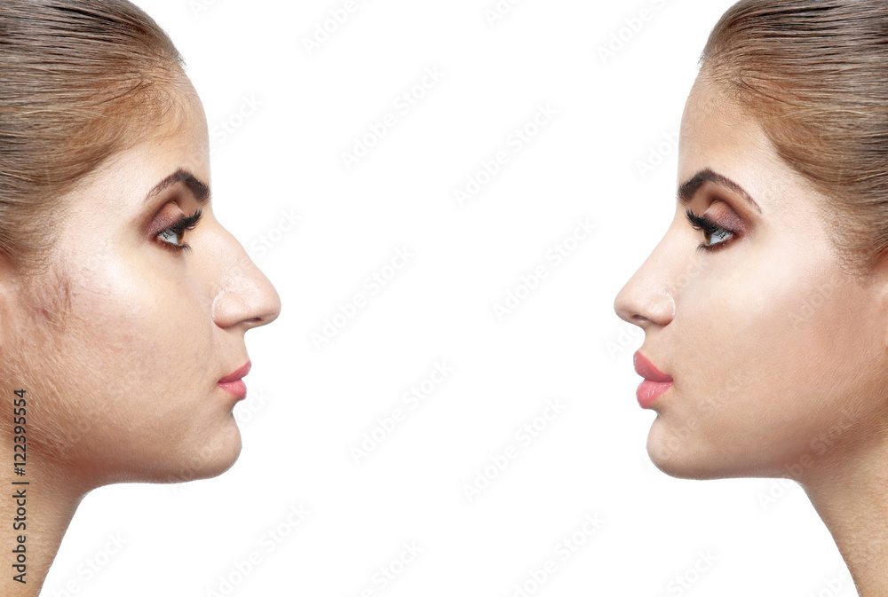 Woman face before and after cosmetic procedure. Plastic surgery concept.