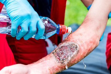 Cooling third degree burn with water. Paramedic training, professional injury make-up