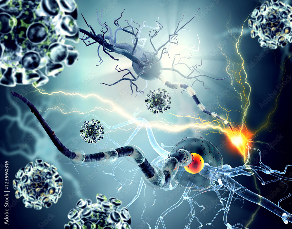 Damaged nerve cells, concept for neurodegenerative and neurological ...