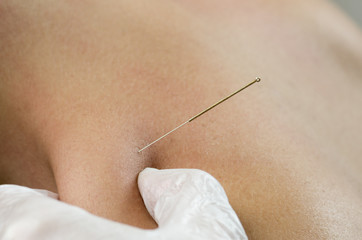 Closeup of a needle and hands of physiotherapist doing a dry needling.