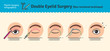 Vector Illustrated set with double eyelid surgery. Non-incisional technique