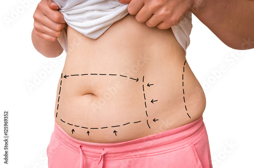 Fotografie, Obraz Plastic surgery doctor draw lines with marker on patient belly