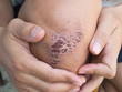 wound scab on the human skin
