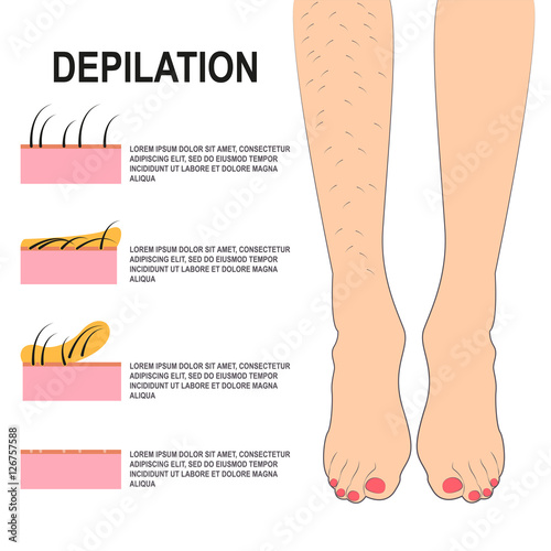 Depilation Vector illustration Female legs before and after waxing